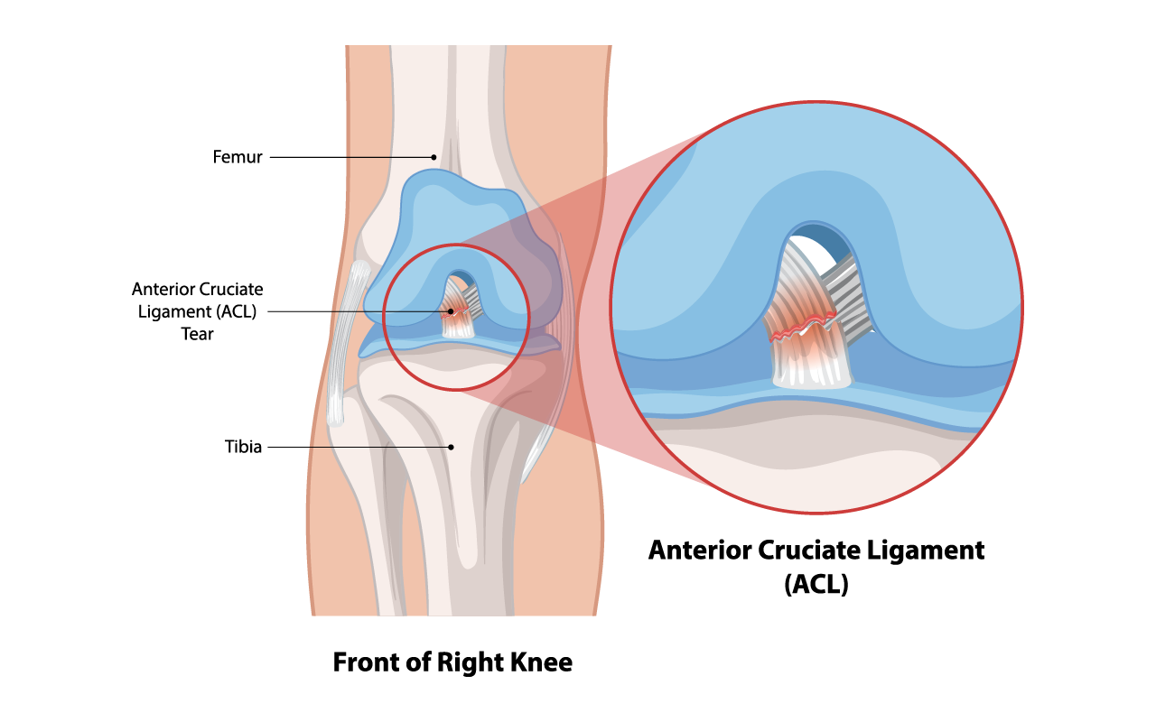Diagram showing an Anterior Cruciate Ligament (ACL) tear in the knee