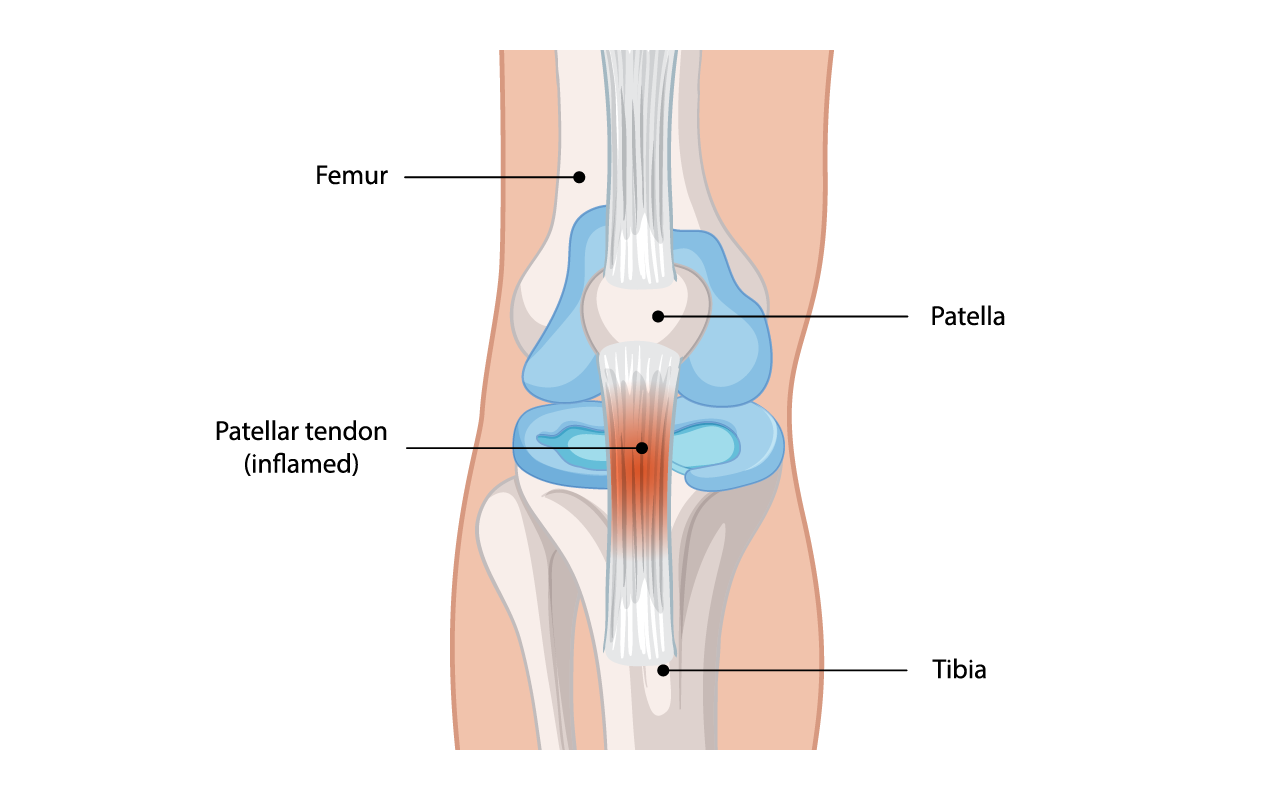 Illustration of jumper's knee (Patellar Tendonitis)