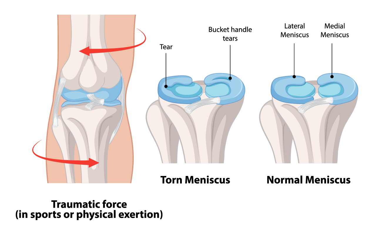 Illustration of a meniscus tear in the knee joint