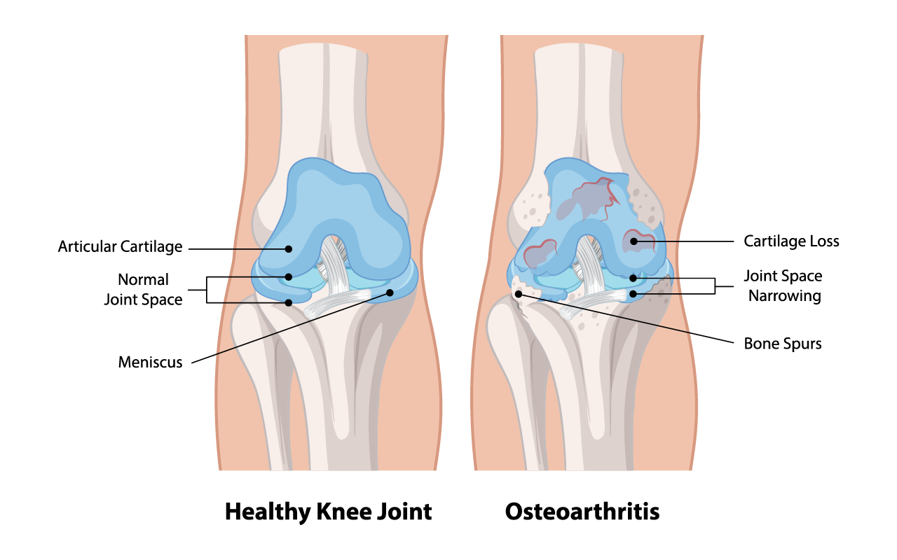 X-ray illustration of knee osteoarthritis showing joint degeneration