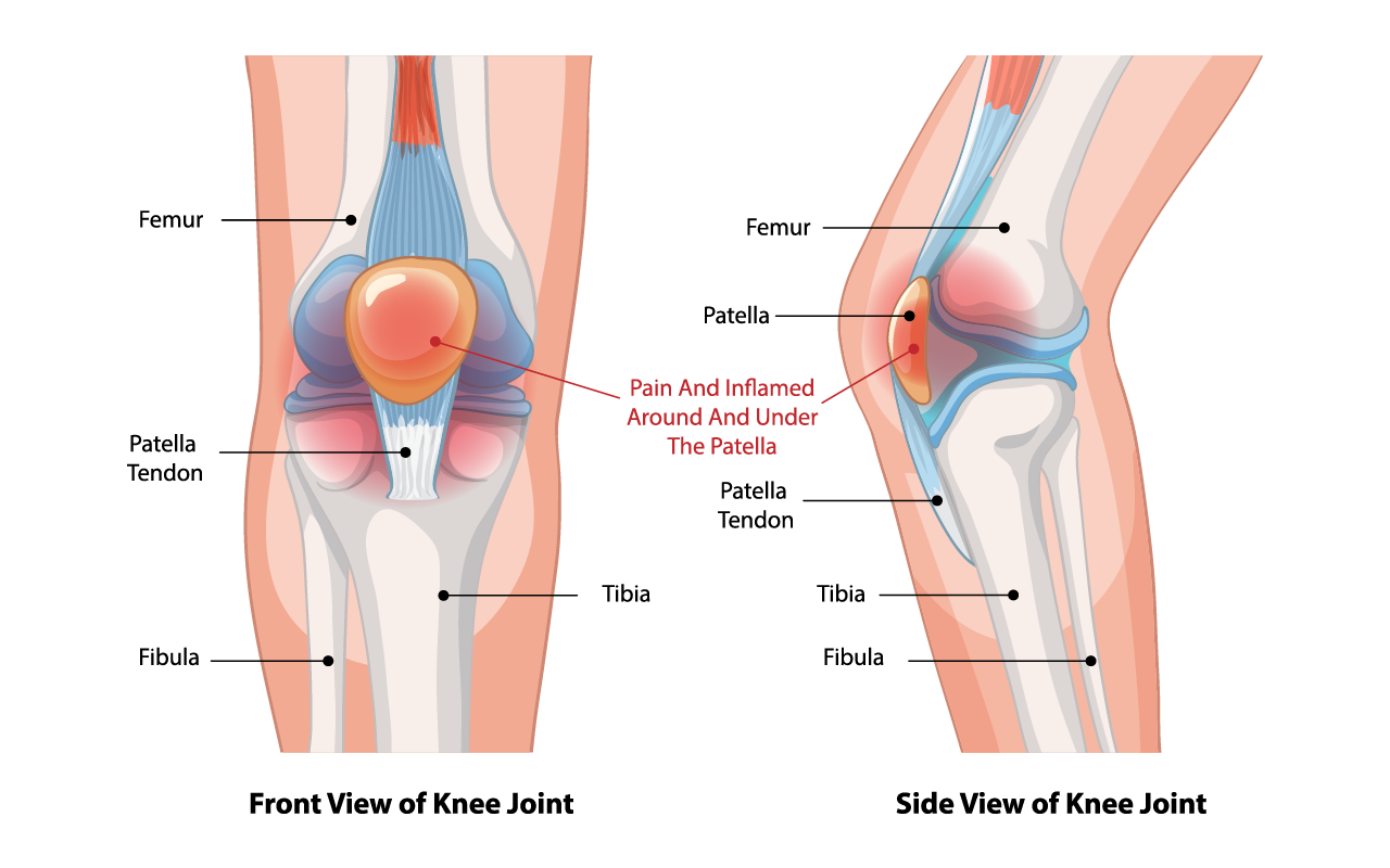 Illustration of runner's knee (Patellofemoral Pain Syndrome)