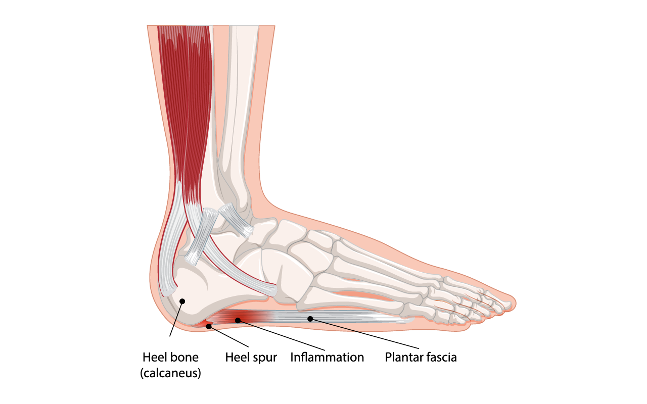 Diagram of the plantar fascia — the bowstring-like ligament that supports the arch of the foot